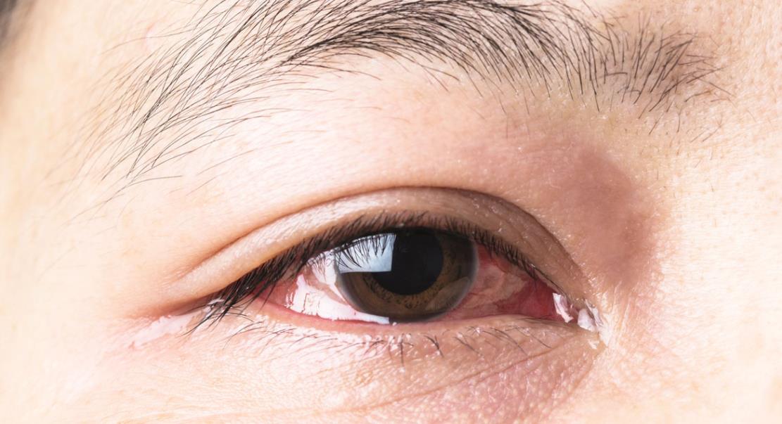 A Comprehensive Guide to Common Eye Problems
